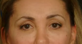 Eyelid Surgery Enhances Your Appearance And Youthful Look