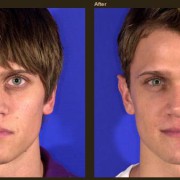 The Need and Basics Of Rhinoplasty For Men
