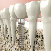 Tips For Choosing A Cosmetic Dentist